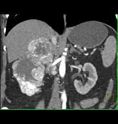 Renal Cell Carcinoma With Adrenal Metastases - CTisus CT Scan