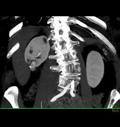 Renal Cell Carcinoma - CTisus CT Scan