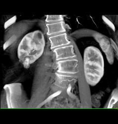 Renal Cell Carcinoma - CTisus CT Scan