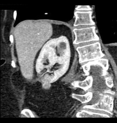 Renal Cell Carcinoma - CTisus CT Scan