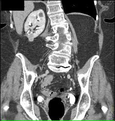 Renal Cell Carcinoma - CTisus CT Scan