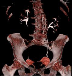 Renal Cell Carcinoma - CTisus CT Scan