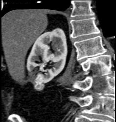 Renal Cell Carcinoma - CTisus CT Scan