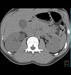 Subtle Acute Pyelonephritis in the Right Kidney - CTisus CT Scan