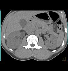 Subtle Acute Pyelonephritis in the Right Kidney - CTisus CT Scan