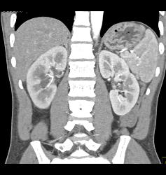 Subtle Acute Pyelonephritis in the Right Kidney - CTisus CT Scan