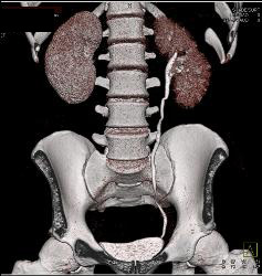 Subtle Acute Pyelonephritis in the Right Kidney - CTisus CT Scan