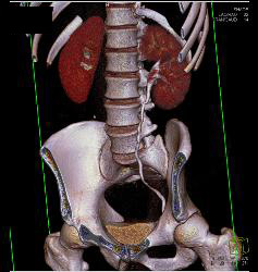 Subtle Acute Pyelonephritis in the Right Kidney - CTisus CT Scan