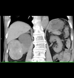 Solid Renal Cell Carcinoma - CTisus CT Scan