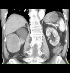 Solid Renal Cell Carcinoma - CTisus CT Scan