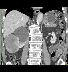 Solid Renal Cell Carcinoma - CTisus CT Scan