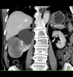 Solid Renal Cell Carcinoma - CTisus CT Scan