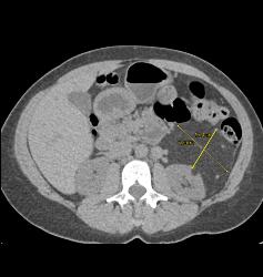 Renal Angiomyelolipoma - CTisus CT Scan