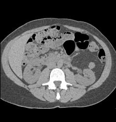 Renal Angiomyelolipoma - CTisus CT Scan