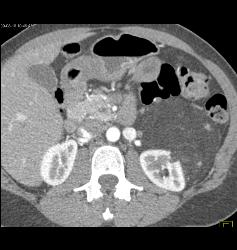 Renal Angiomyelolipoma - CTisus CT Scan