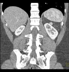 Renal Angiomyelolipoma - CTisus CT Scan