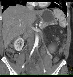 Renal Angiomyelolipoma - CTisus CT Scan