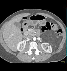 Renal Angiomyelolipoma - CTisus CT Scan