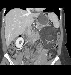 Renal Angiomyelolipoma - CTisus CT Scan