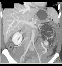 Renal Angiomyelolipoma - CTisus CT Scan