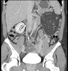 Renal Angiomyelolipoma - CTisus CT Scan