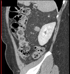 Renal Angiomyelolipoma - CTisus CT Scan