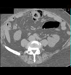 Renal Cell Carcinoma - CTisus CT Scan