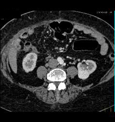 Renal Cell Carcinoma - CTisus CT Scan