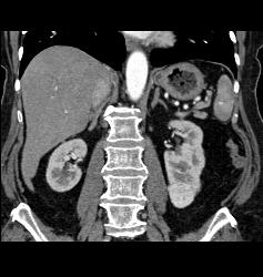 Renal Cell Carcinoma - CTisus CT Scan