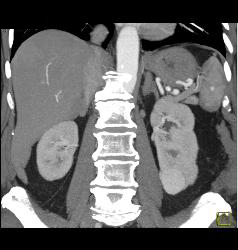 Renal Cell Carcinoma - CTisus CT Scan