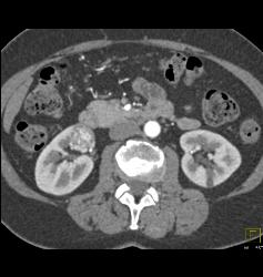 2 Cm Renal Cell Carcinoma - CTisus CT Scan