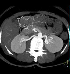 2 Cm Renal Cell Carcinoma - CTisus CT Scan