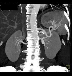 2 Cm Renal Cell Carcinoma - CTisus CT Scan