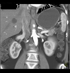 2 Cm Renal Cell Carcinoma - CTisus CT Scan