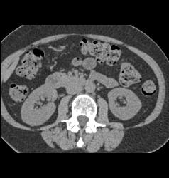 2 Cm Renal Cell Carcinoma - CTisus CT Scan