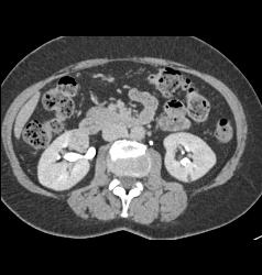 2 Cm Renal Cell Carcinoma - CTisus CT Scan