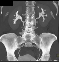 2 Cm Renal Cell Carcinoma - CTisus CT Scan