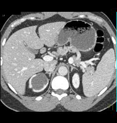 Duplicated Upper Pole Collecting System on the Right - CTisus CT Scan