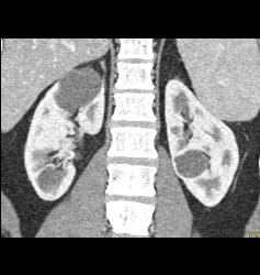 Duplicated Upper Pole Collecting System on the Right - CTisus CT Scan