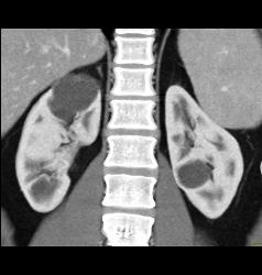 Duplicated Upper Pole Collecting System on the Right - CTisus CT Scan