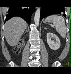 Metastatic Renal Cell Carcinoma to the Right Adrenal and Spleen - CTisus CT Scan