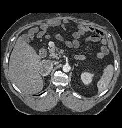 Metastatic Renal Cell Carcinoma to the Right Adrenal and Spleen - CTisus CT Scan