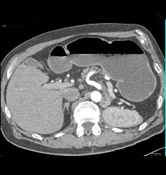 S/p Nephrectomy With Recurrence to Liver - CTisus CT Scan