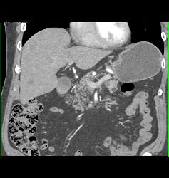 S/p Nephrectomy With Recurrence to Liver - CTisus CT Scan