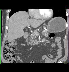 S/p Nephrectomy With Recurrence to Liver - CTisus CT Scan