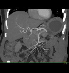 S/p Nephrectomy With Recurrence to Liver - CTisus CT Scan