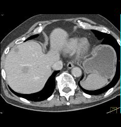 Post Left Nephrectomy With Liver Metastases - CTisus CT Scan