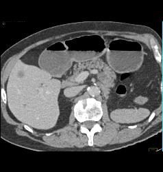 Post Left Nephrectomy With Liver Metastases - CTisus CT Scan