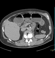 Post Left Nephrectomy With Liver Metastases - CTisus CT Scan