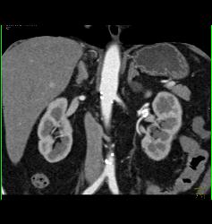 Normal CT Urogram With Left Renal Artery Aneurysm - CTisus CT Scan